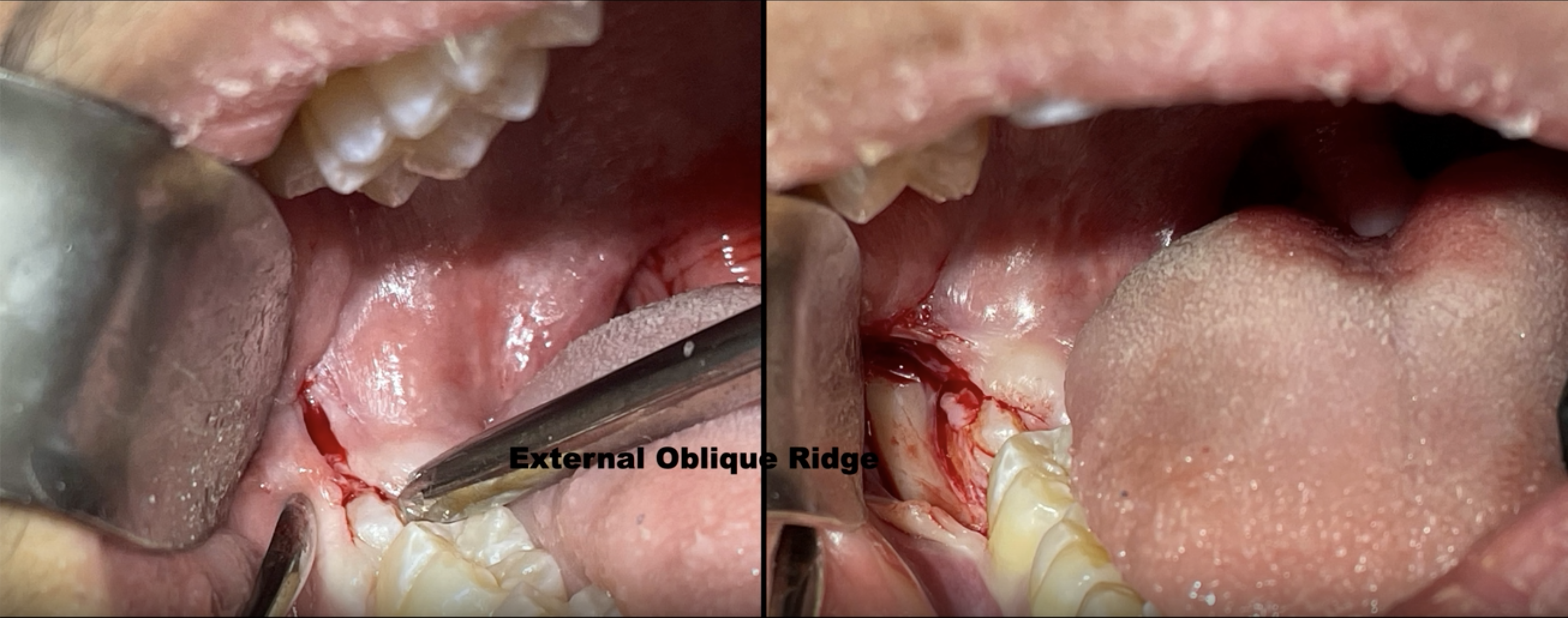 incision design 2.png