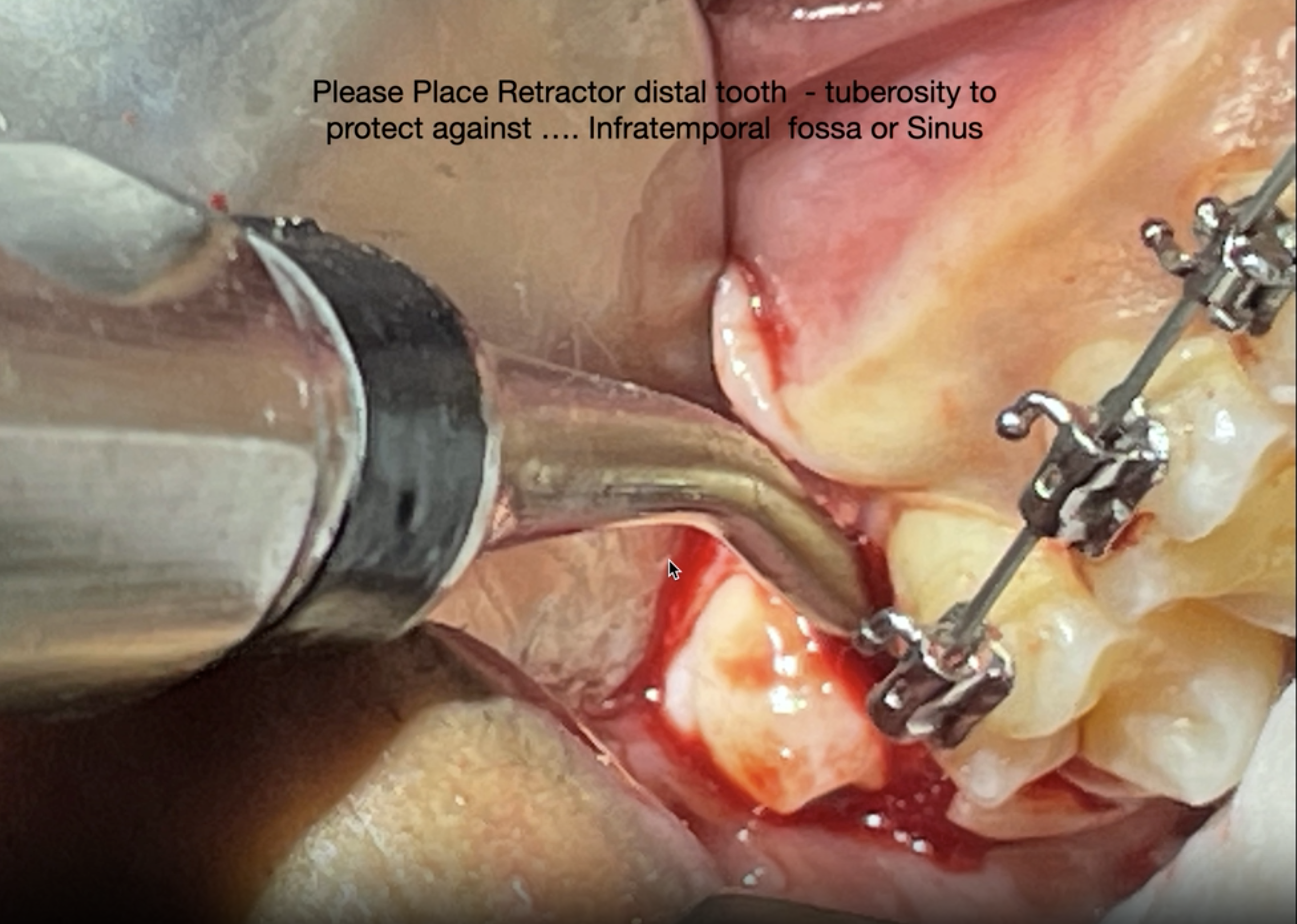 3rd maxillary molar avoid infratemporal.png