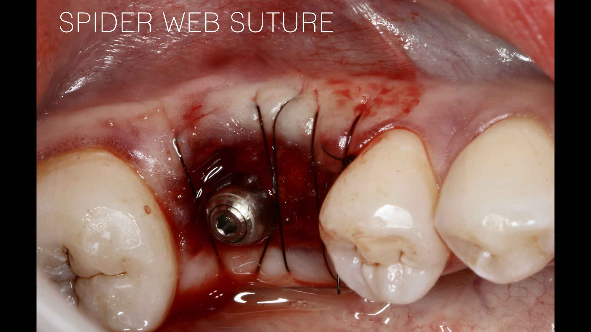 ‎SPIDERWEB SUTURE Henrique Burmester.‎026.jpeg