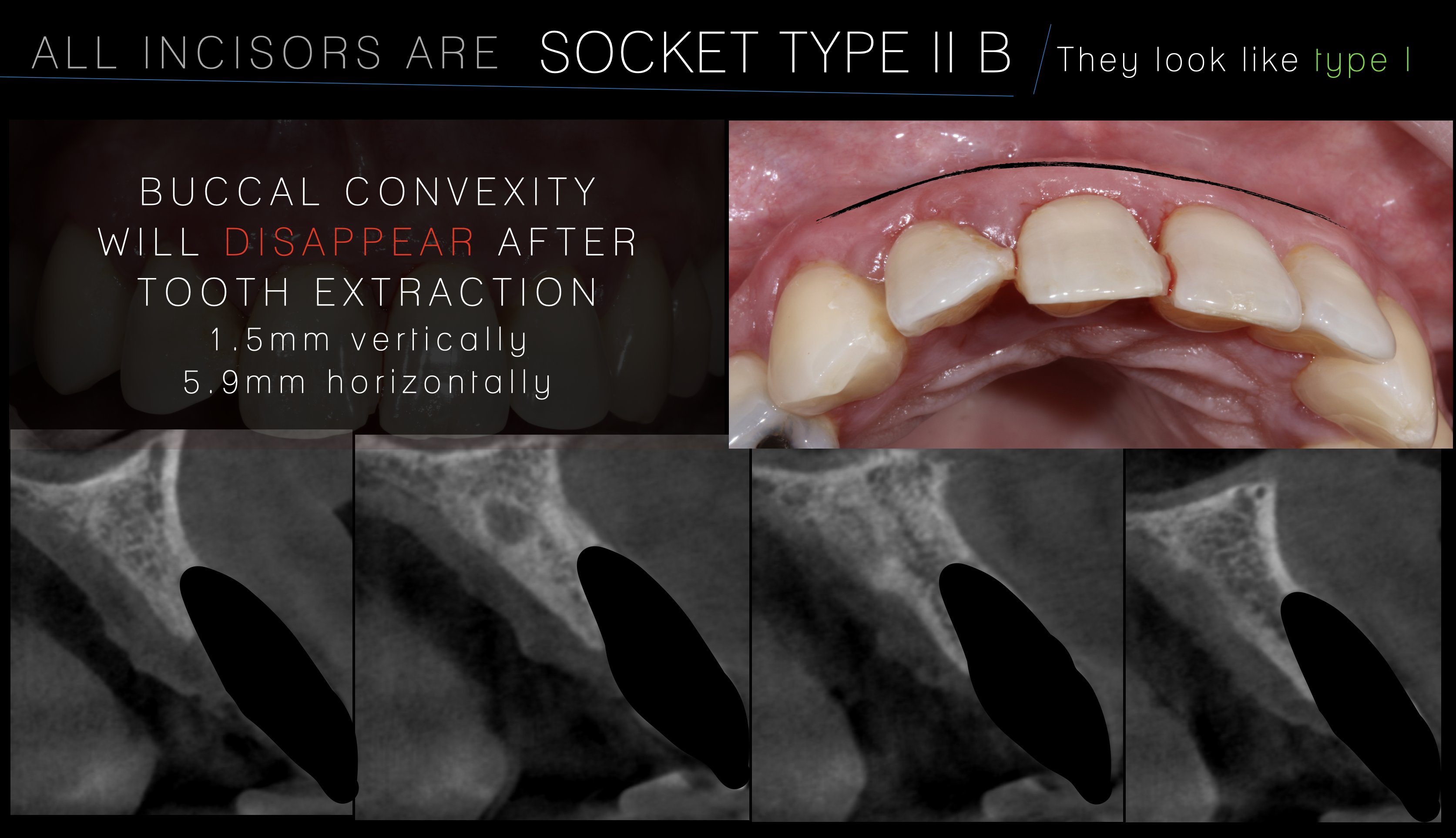 buccal bone resorption.png