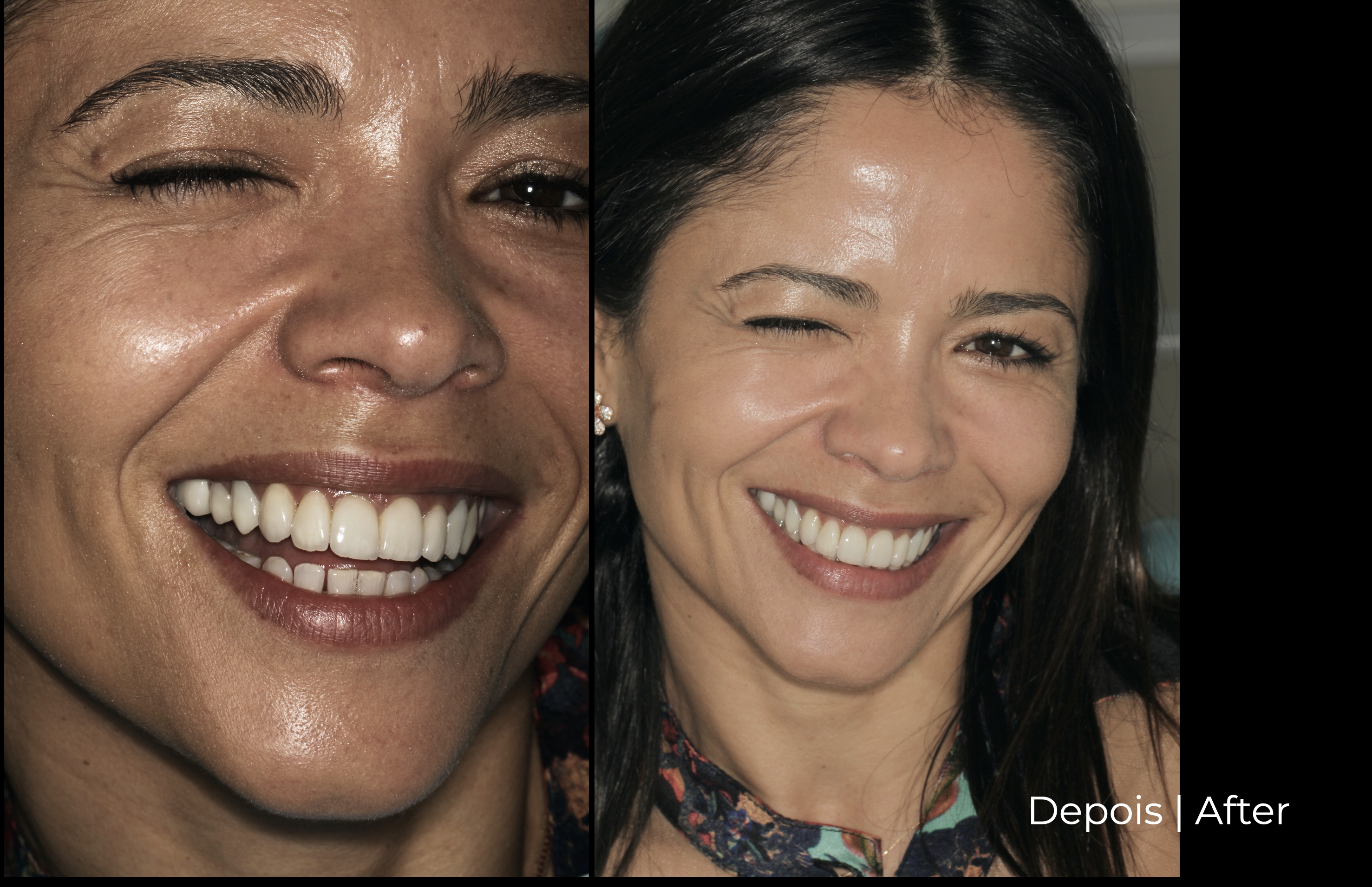 Margarida face incrível depois.png