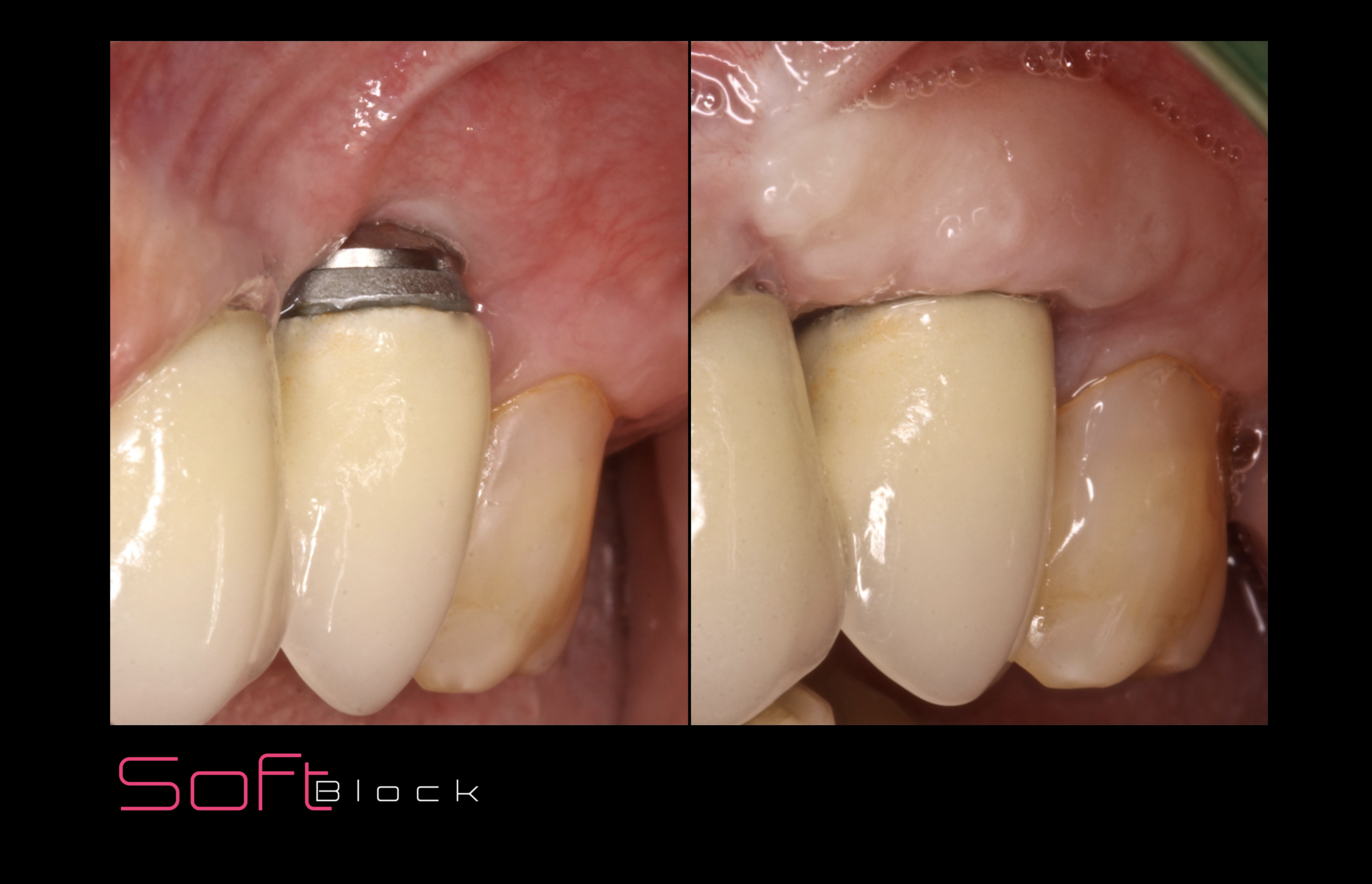 soft block antes e depois.png