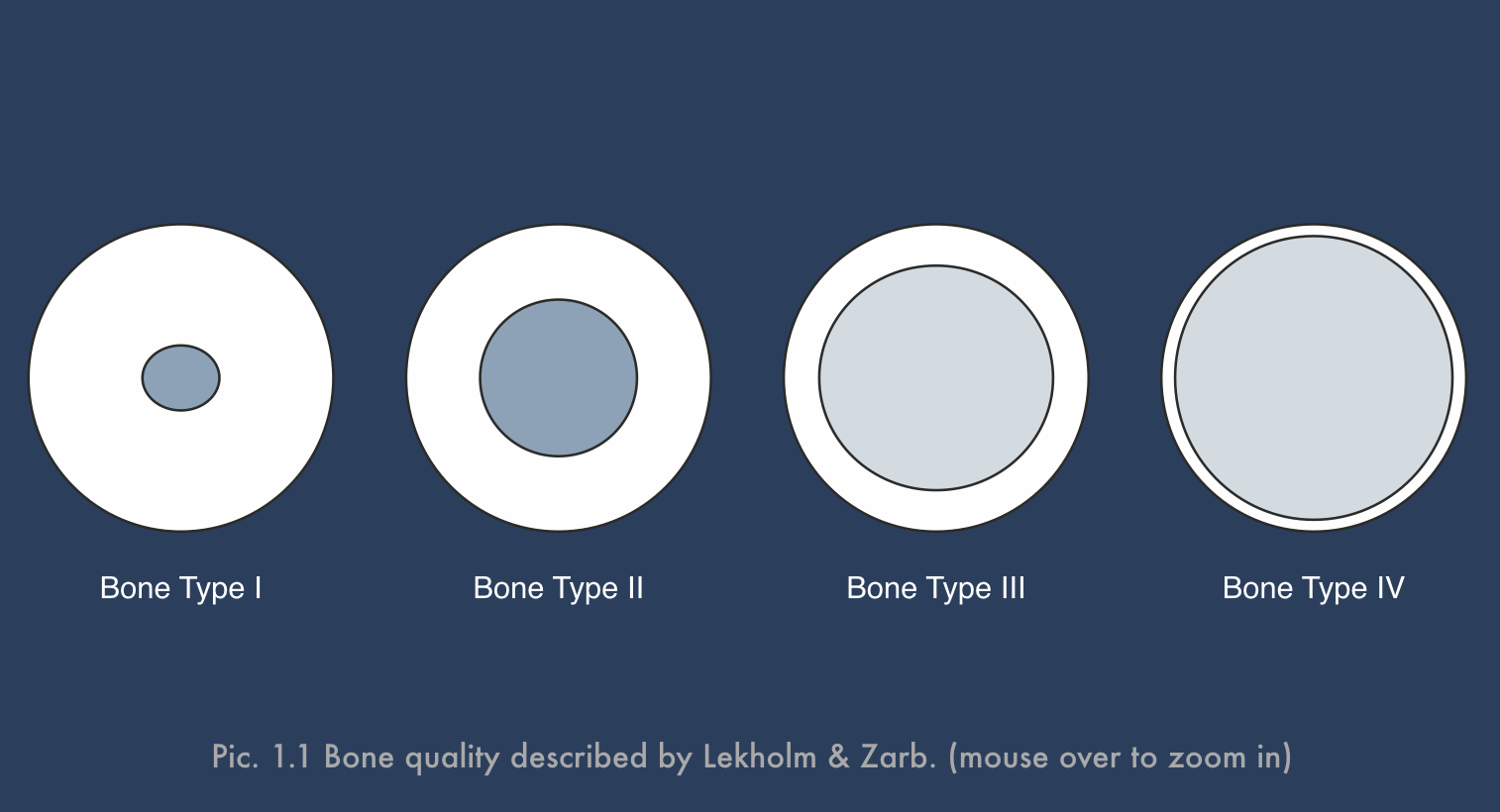 picture 1.1 Lekholm e Zarb Classification.png