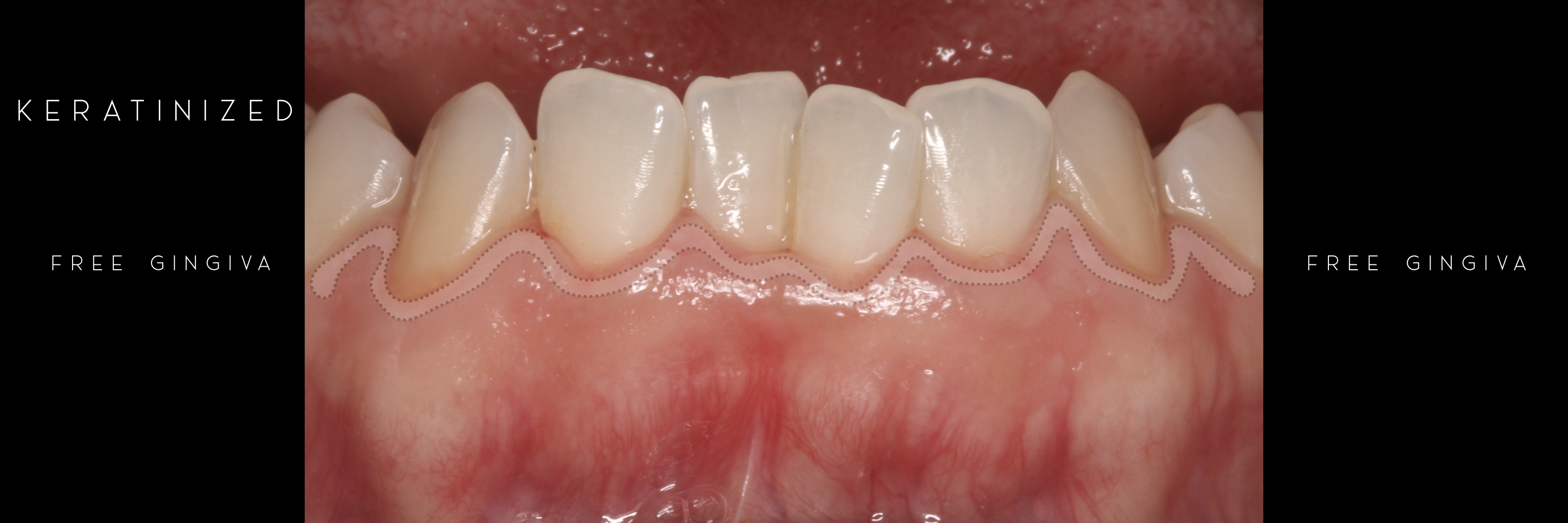keratinized 3 free gingiva marginal.jpeg