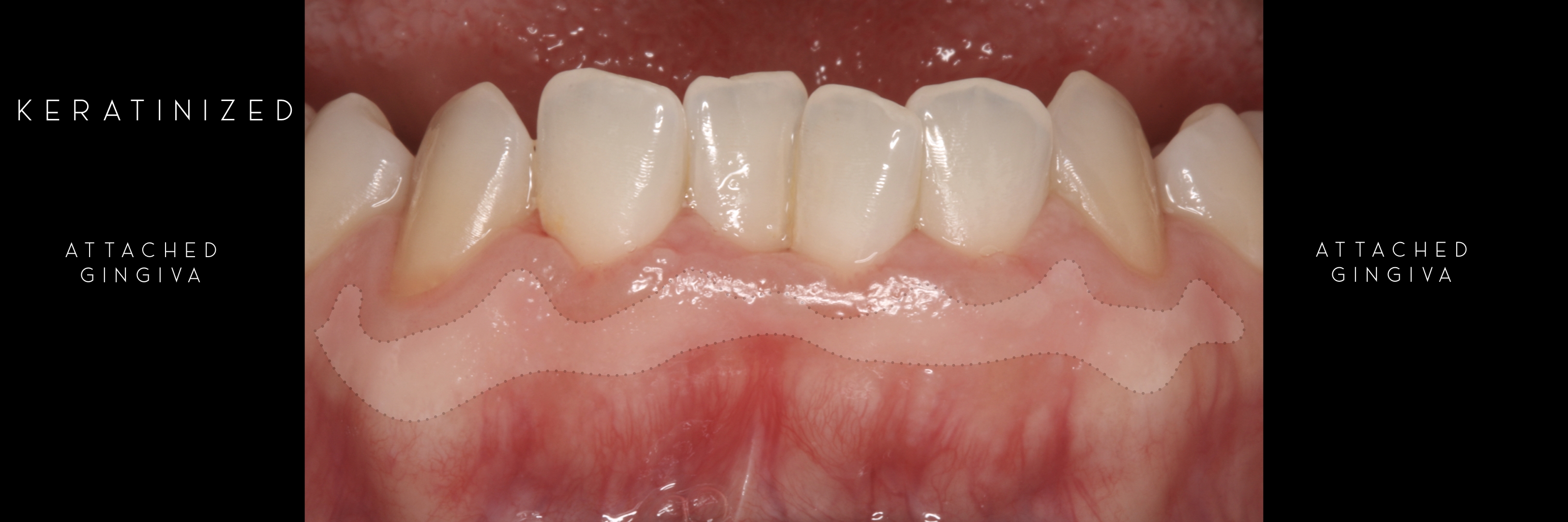 keratinized 4 attached gingiva .jpeg