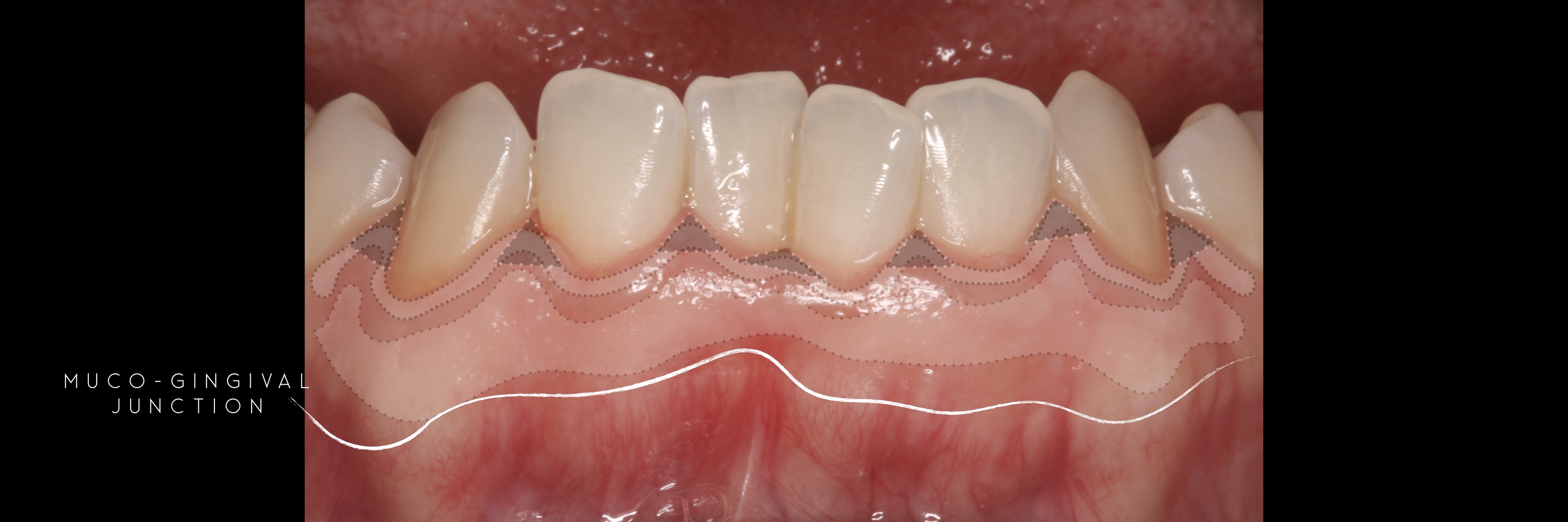 keratinized 7 gingiva ALL MGJ.jpeg