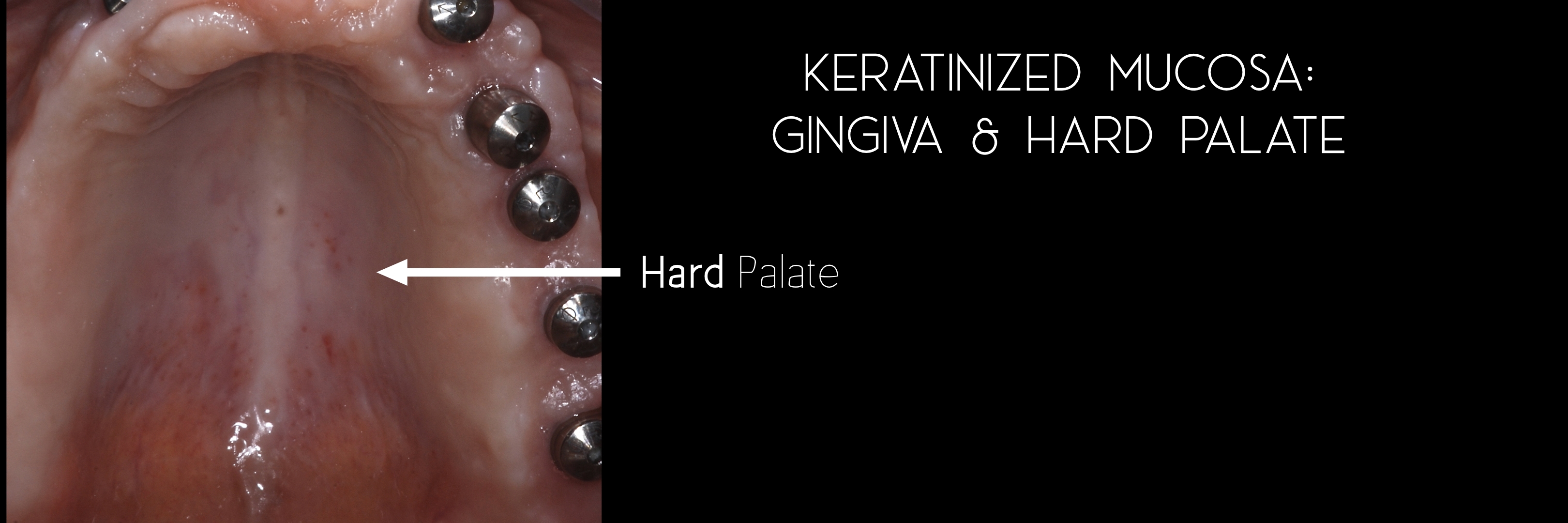 keratinized 1 palate.jpeg