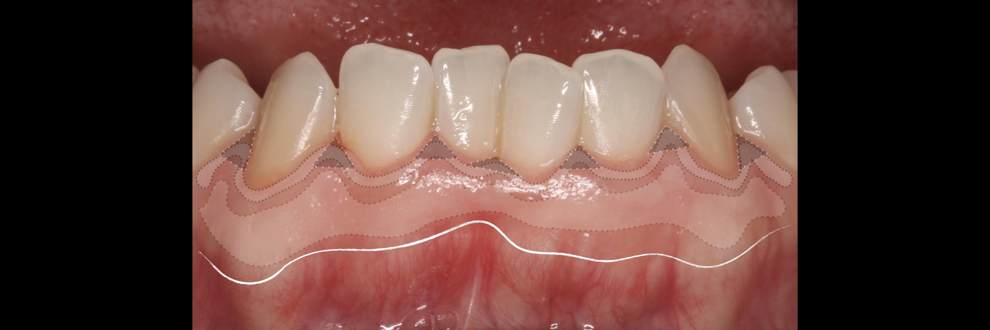 keratinized 6 gingiva ALL .jpeg