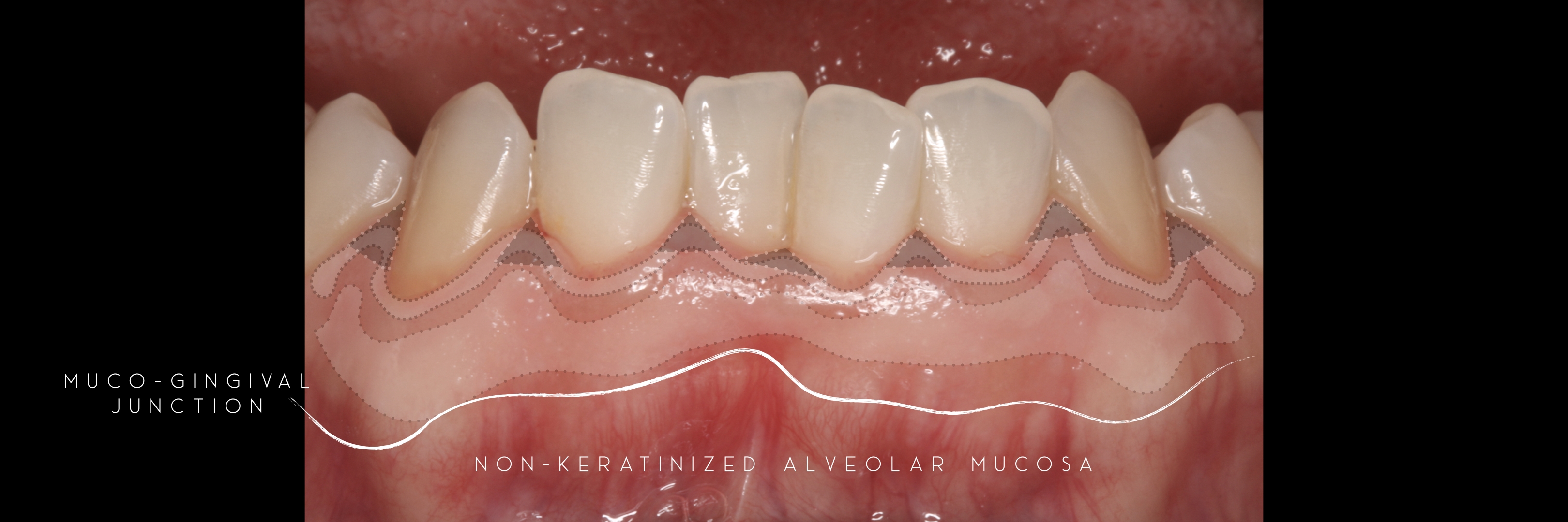 NON keratinized 8 ALVEOLAR MUCOSA.jpeg