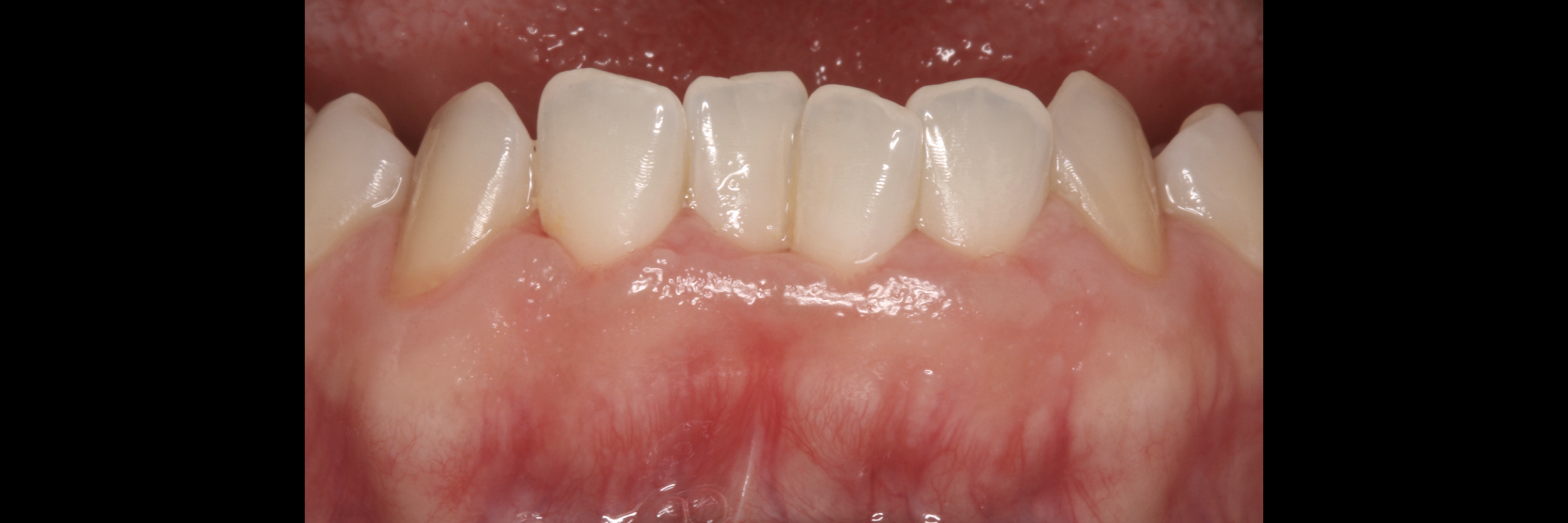 keratinized 2 teeth.jpeg