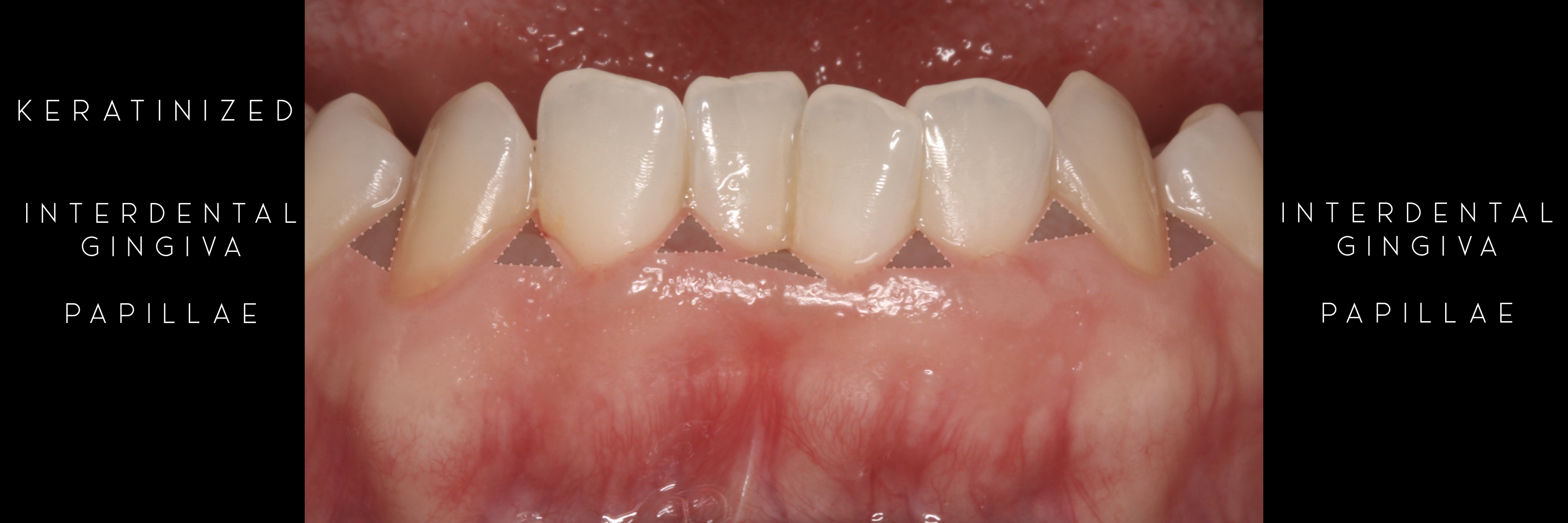keratinized 5 interdental gingiva .jpeg
